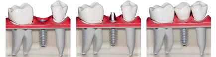 Clínica Dental M. V. Romero secuencia de implantes