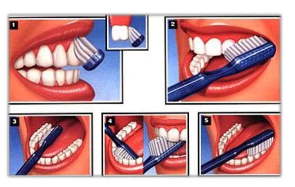 Clínica Dental M. V. Romero -tecnica de cepillad
