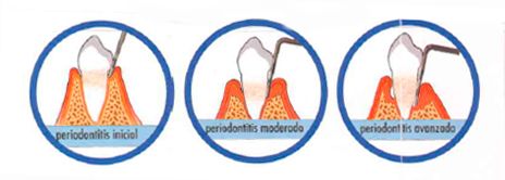 Clínica Dental M. V. Romero periodoncia